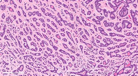 Adenoid Histology