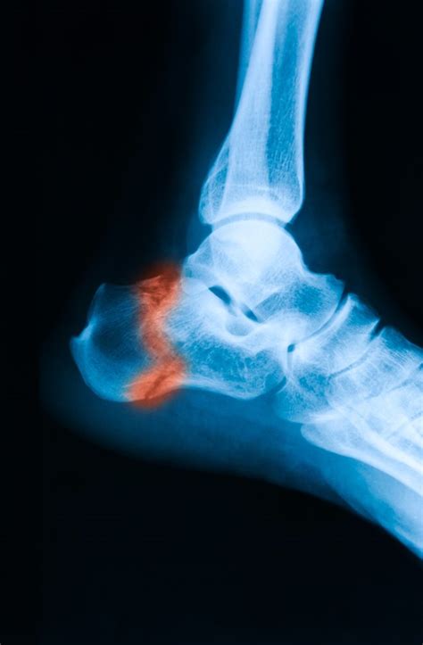 Complications of ORIF Ankle Surgery | Livestrong.com