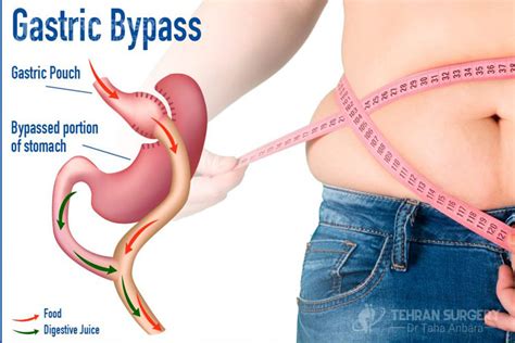 Gastric bypass risks and complications - Complications of bypass surgery