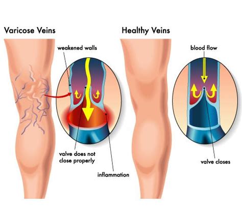 Symptoms Of Varicose Vein Disease