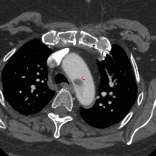 Follow Up Cta Aortogram Three Months Following Discharge Showing Total