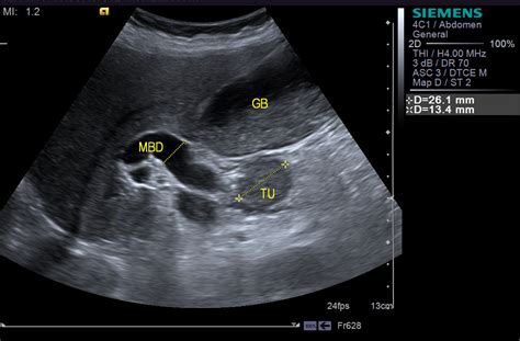 Contrast‐enhanced Ultrasound For The Assessment Of Pancreatic Lesions Intechopen