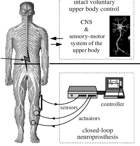 Scheme Of A Paraplegic Patient Equipped With A Closed Loop Controlled