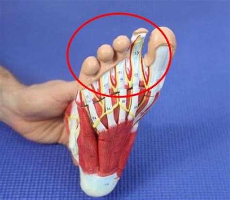 Capsulitis of the Second Toe Treatment [Taping, Orthotics & Best Shoes!]