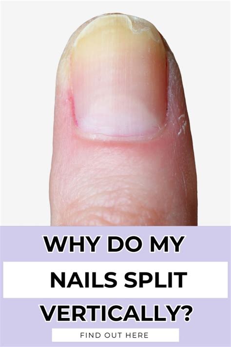 5 Secret Causes Of Vertical Nail Splits In 2024 Split Nails Nail