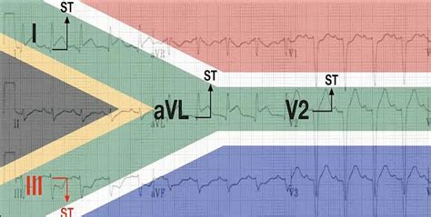 Cambios en el electrocardiograma en el signo de la bandera de Sudáfrica