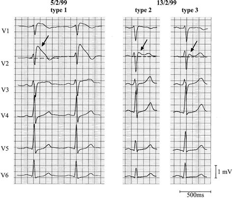 Proposed Diagnostic Criteria For The Brugada Syndrome Circulation