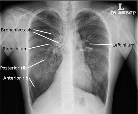 Bronchiectasis X Ray