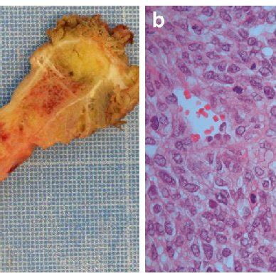 examination  tumour tissue  macroscopic examination  tumour