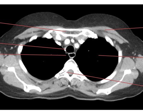 Schaubild Schnittbildanatomie Thorax 1 Quizlet