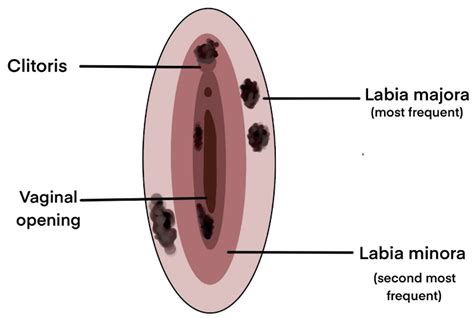 Vulvar Melanoma Staging