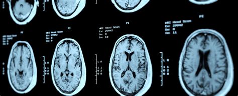 Brain Tumor Patient And Caregiver Guide