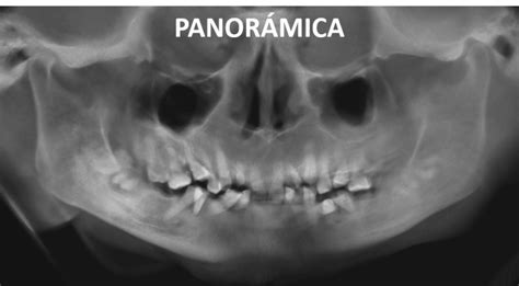 Anquilosis de la ATM Dento Metric Radiología Dental Oral y