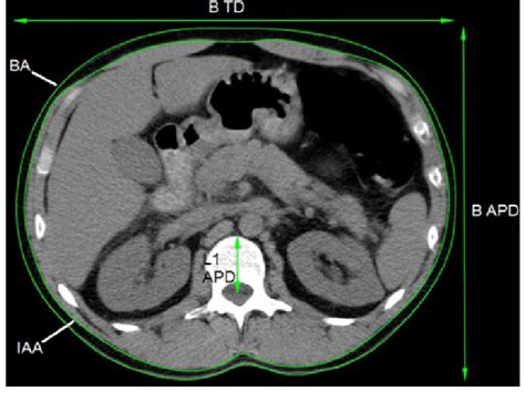 Computed Tomography Ct Slice At L1 Vertebral Level Showing Download Scientific Diagram