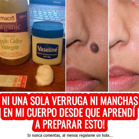 ELIMINA LAS VERRUGAS GENITALES Y FACIALES LUNARES FIBROMAS