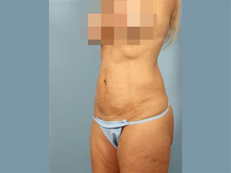 Renuvion Jplasma Body Contouring Before Afters Dr Andrew Lyos