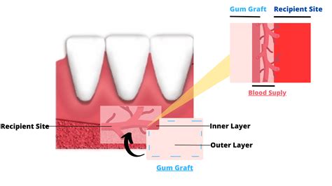 My Gum Graft is Turning White as It Heals, Reasons Week by Week