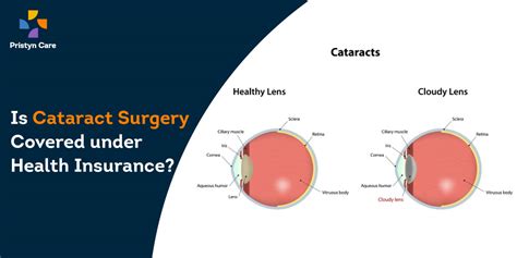 Is Cataract Surgery Covered Under Health Insurance In India