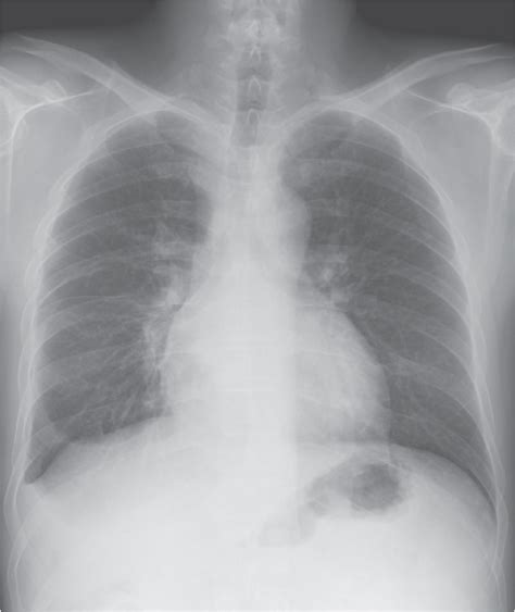 Figure From Remission Of Refractory Hepatic Hydrothorax In Patient