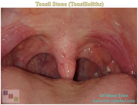 Tonsil Stone Definition Symptoms And Treatment