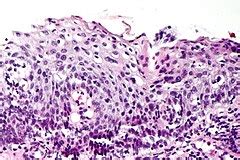 High-grade squamous intraepithelial lesion - Libre Pathology