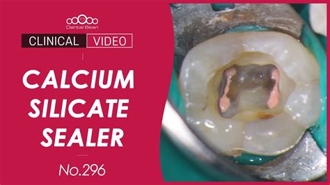 Sealer Based Obturation With Calcium Silicate Sealer Dr Cho Sunggeun