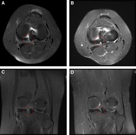 Outcomes Of Arthroscopic All Inside Repair Are Improved Compared To