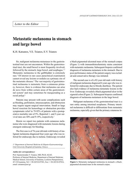 (PDF) Metastatic melanoma in stomach and large bowel