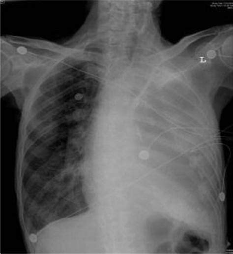 Chest radiograph on presentation showing complete | Download Scientific Diagram