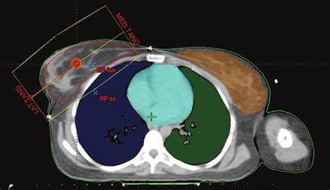 Patient Anatomy Showing Breast Planning Target Volume PTV And OARs