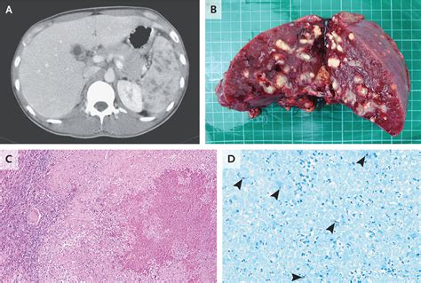 Splenic Tuberculosis Nejm