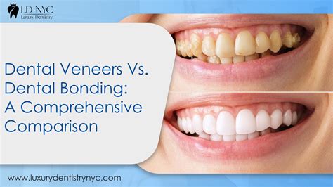 Dental Veneers Vs Dental Bonding A Comprehensive Comparison Luxury