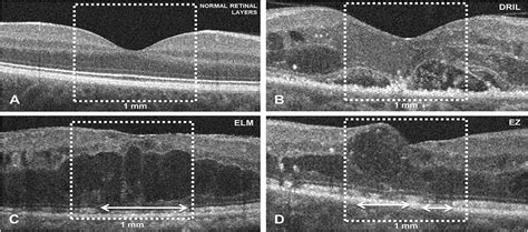 Optical Coherence Tomography Baseline Predictors For Initial Retina