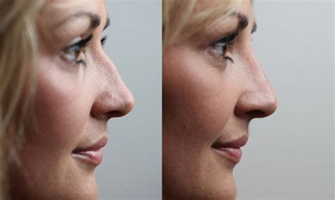 The No Knife Nose Job The Revolutionary Procedure That Smooths Out