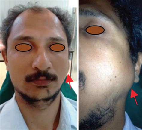 Swelling Present In The Front Of The Preauricular Region On The Left