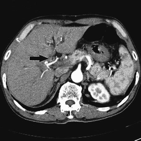 The Abdominal Computed Tomography Shows Both Intrahepatic Duct