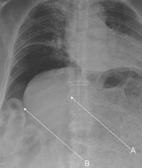 Massive Pneumoperitoneum The Western Journal Of Emergency Medicine