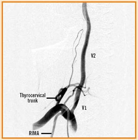 Vertebral Artery Segments Stenosis And Artery Dissection Symptoms