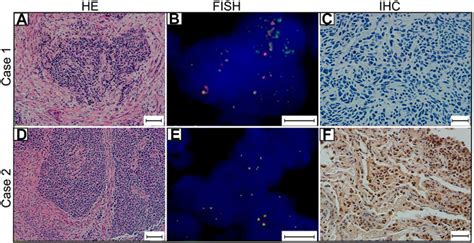 POR MYCL1 Amplification And Expression Of L Myc And C Myc In