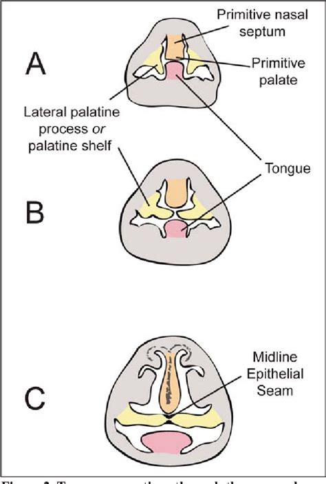 Palatoschisis