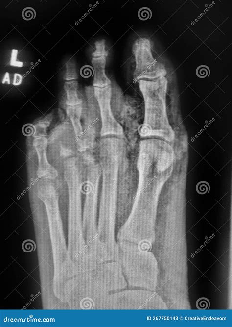 Gangrenous Left Foot in Diabetic Patient - Soft Tissue Gas on Xray