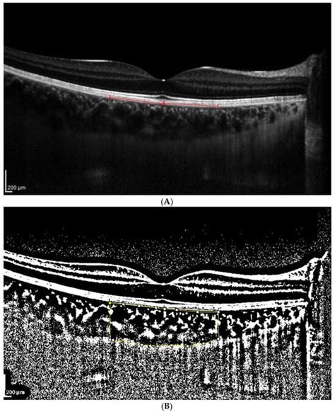 Jcm Free Full Text Impact Of Brightness On Choroidal Vascularity Index