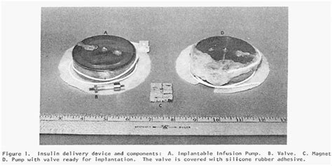 The Implantable Insulin Pump History Chapter One