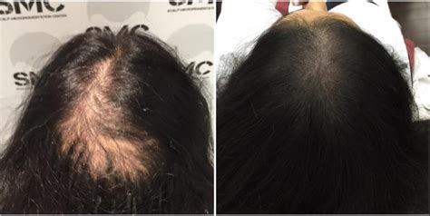 Transplantation Capillaire Vs Micropigmentation Du Cuir Chevelu