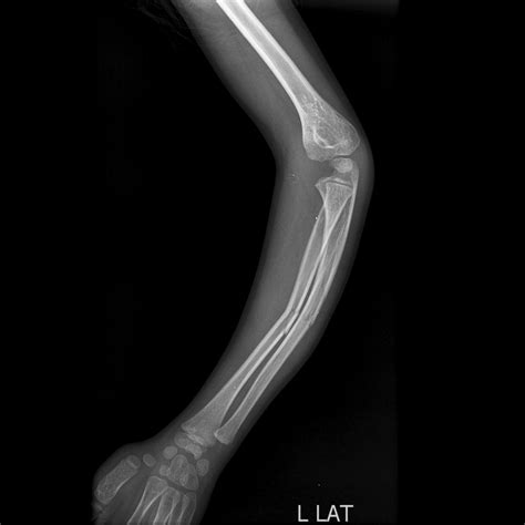 Greenstick Fracture X Ray