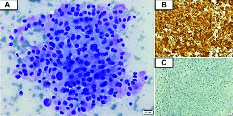 A Photomicrograph Of Fine Needle Aspiration Fna Smear Showing