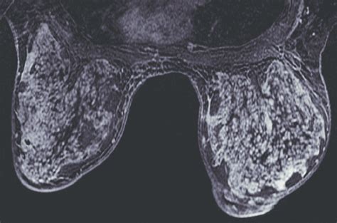 Preoperative Magnetic Resonance Imaging MRI Of Both Breasts MRI