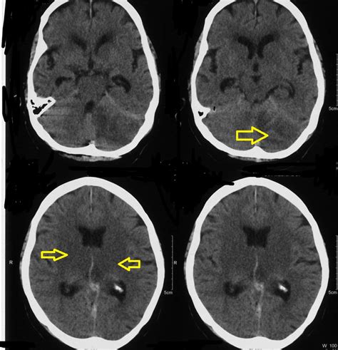 Cerebral Venous Thrombosis Superficial Deep Venous System Case