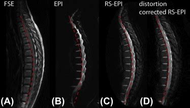 Susceptibility Artifacts Radiology Key