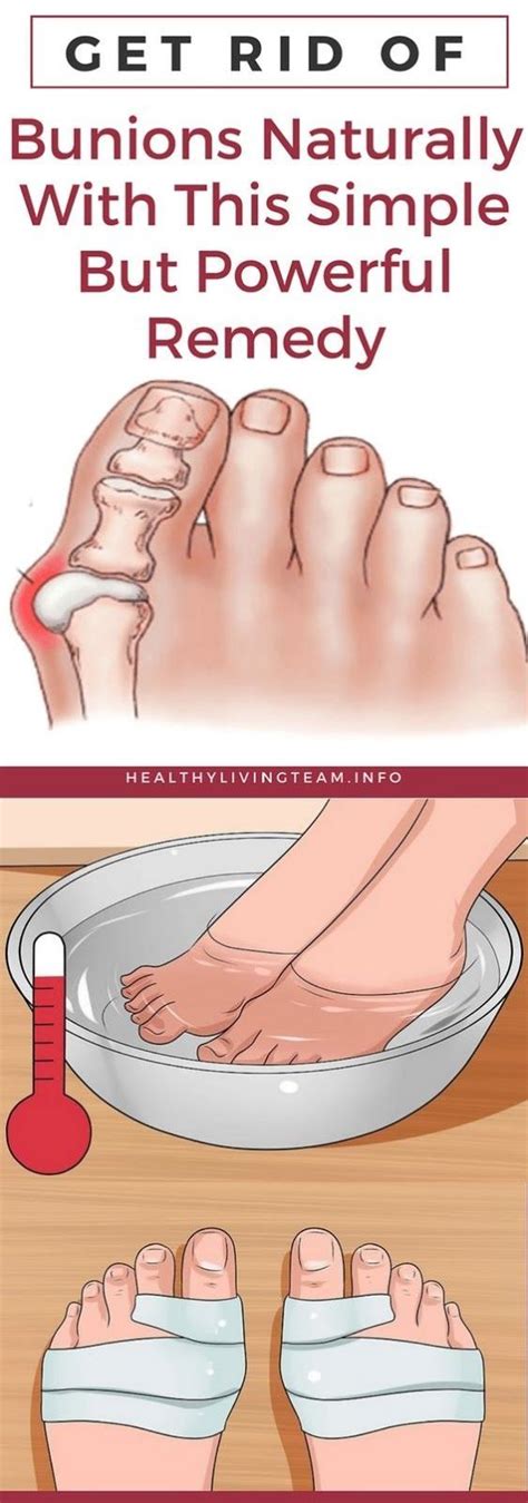 Get Rid Of Bunions Naturally With This Simple But Powerful Remedy How